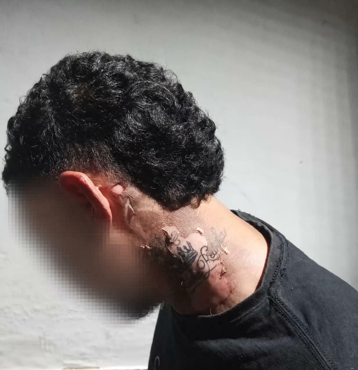 Homem sofre queimaduras após ser atingido por óleo quente em Parauapebas.